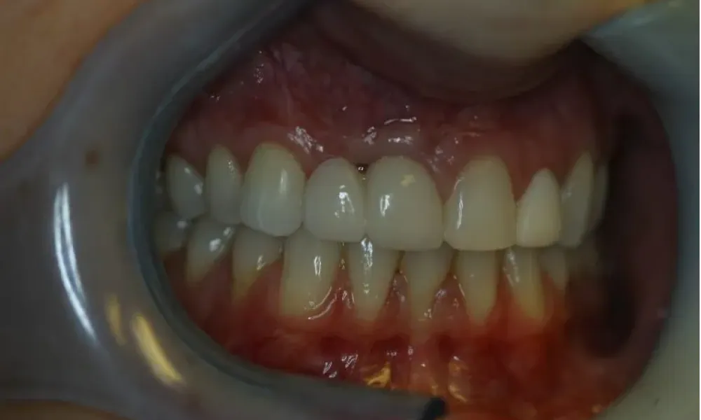 Clinical photo from Hope's smile reconstruction case